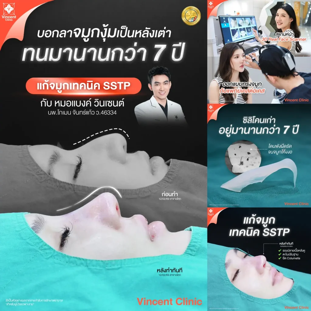 Correcting a hooked nose that had lasted 7 years using the SSTP technique by Dr. Bank