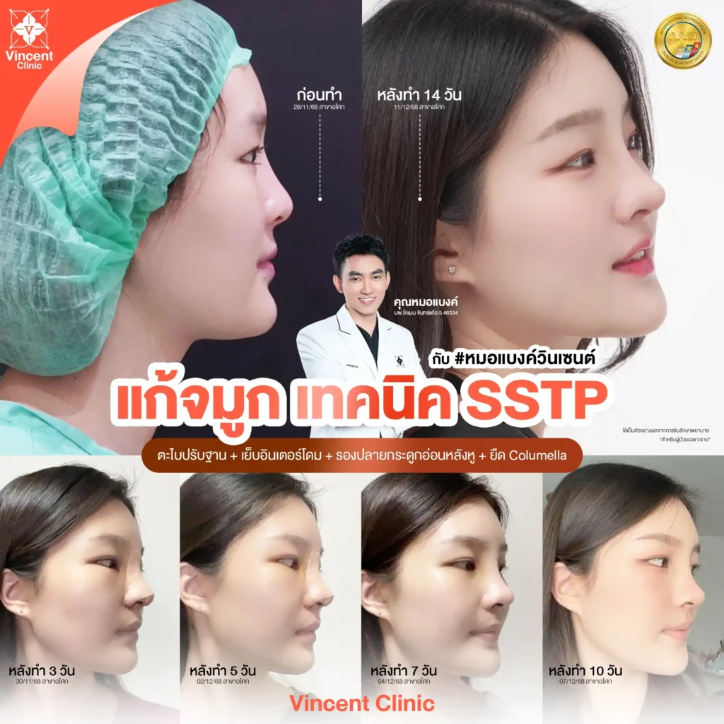 รีวิว แก้จมูก คุณน้ำฝน ทำศัลยกรรมโดยหมอแบงค์