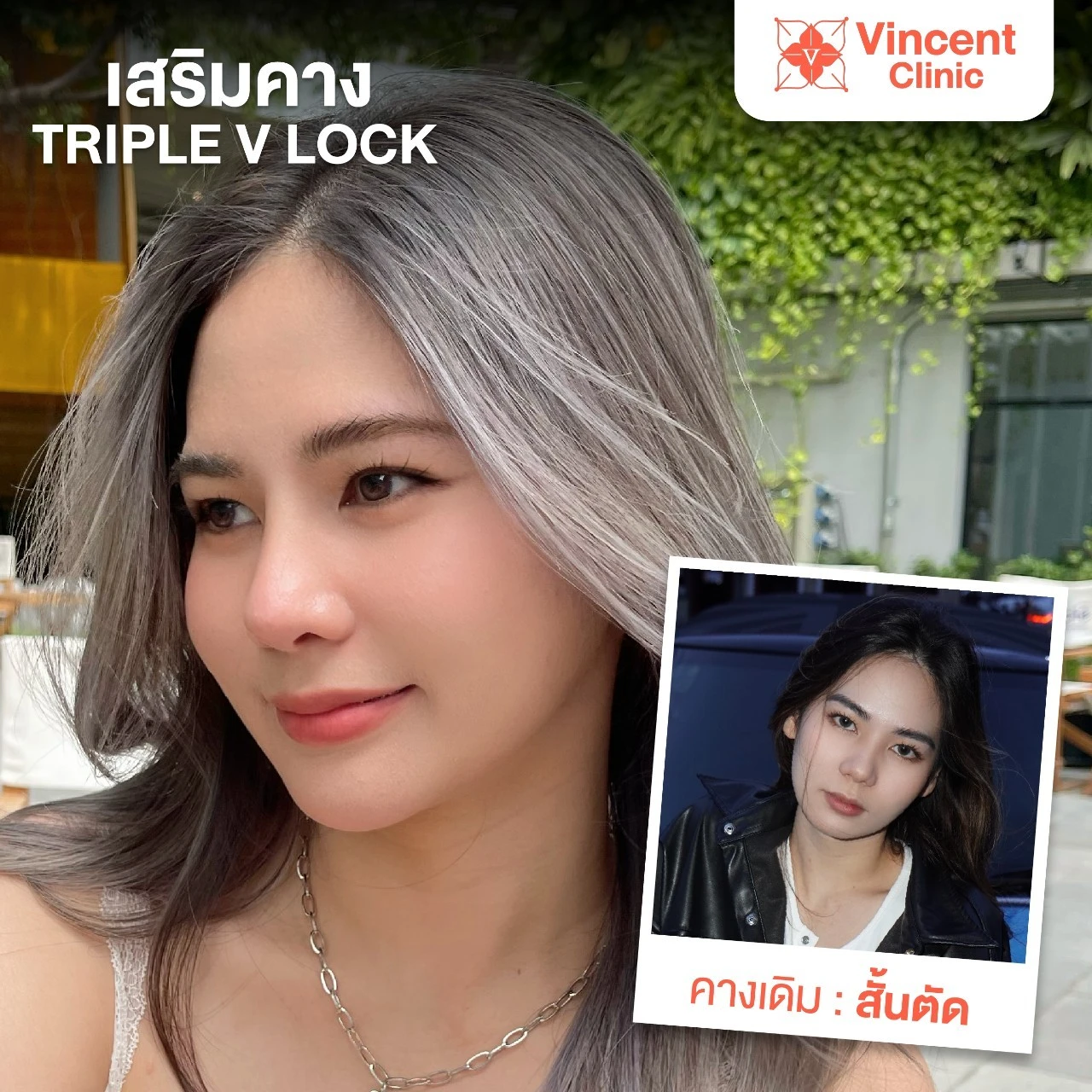 เสริมคาง.webp4