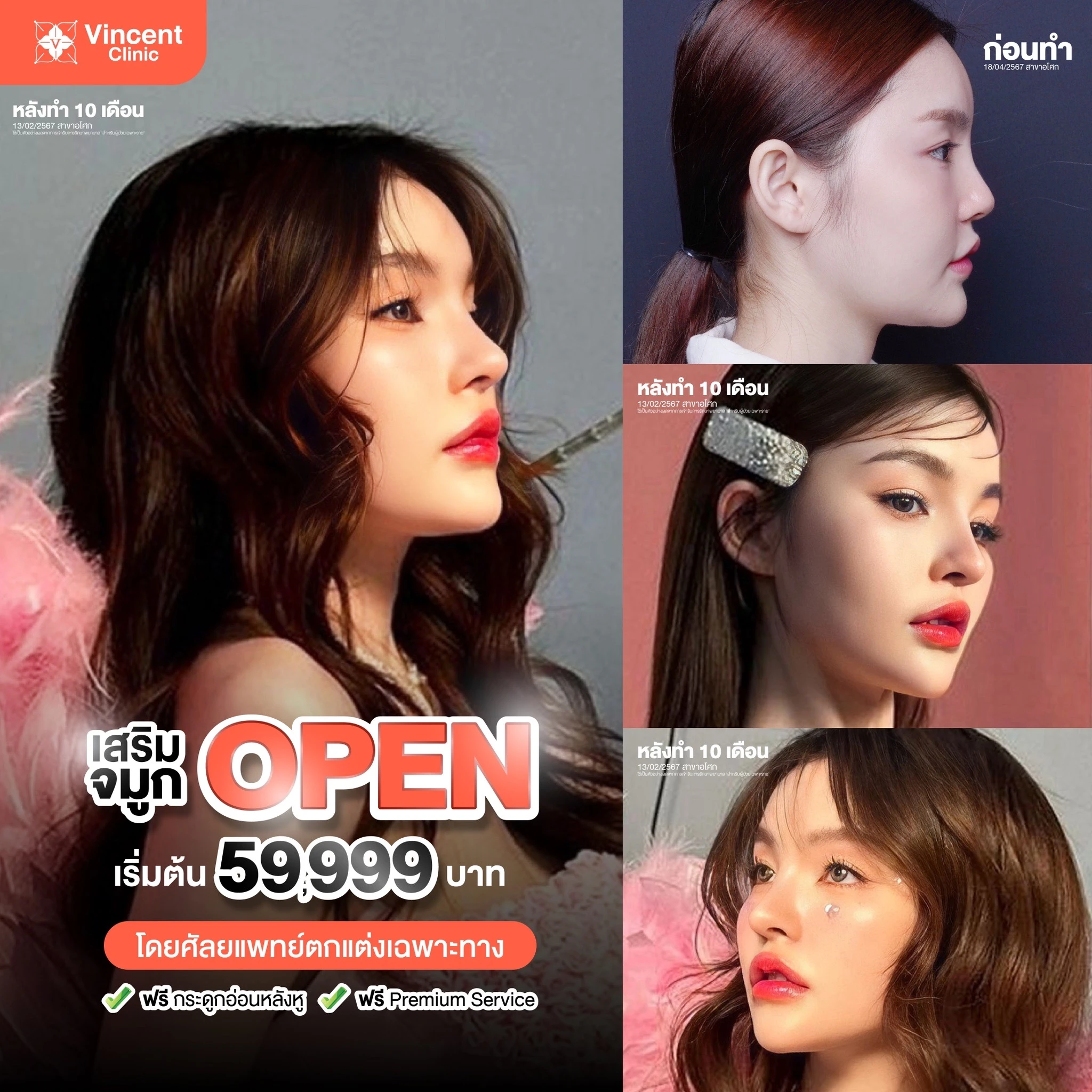 เสริมจมูกopen10