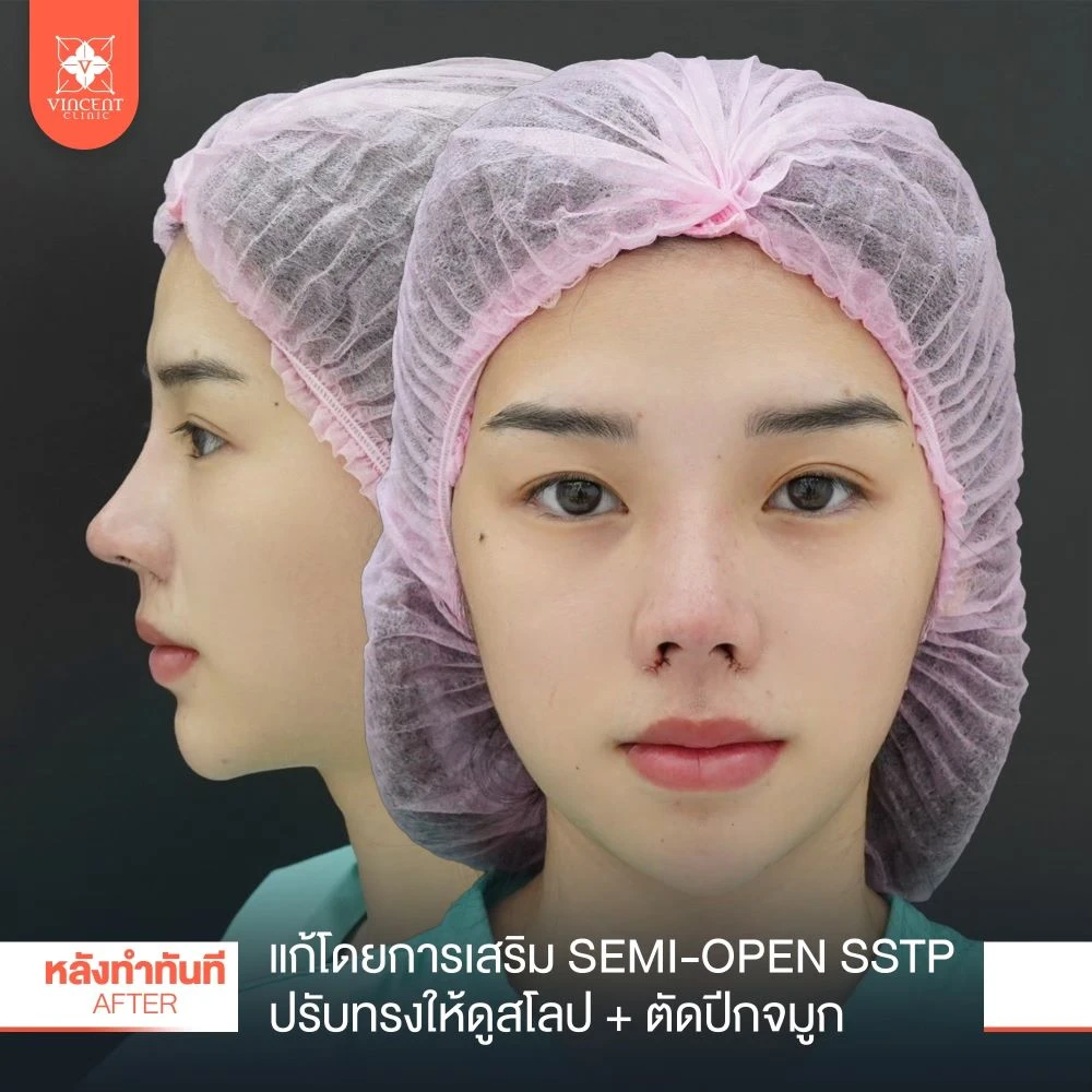 เสริมจมูกsstp.webp5