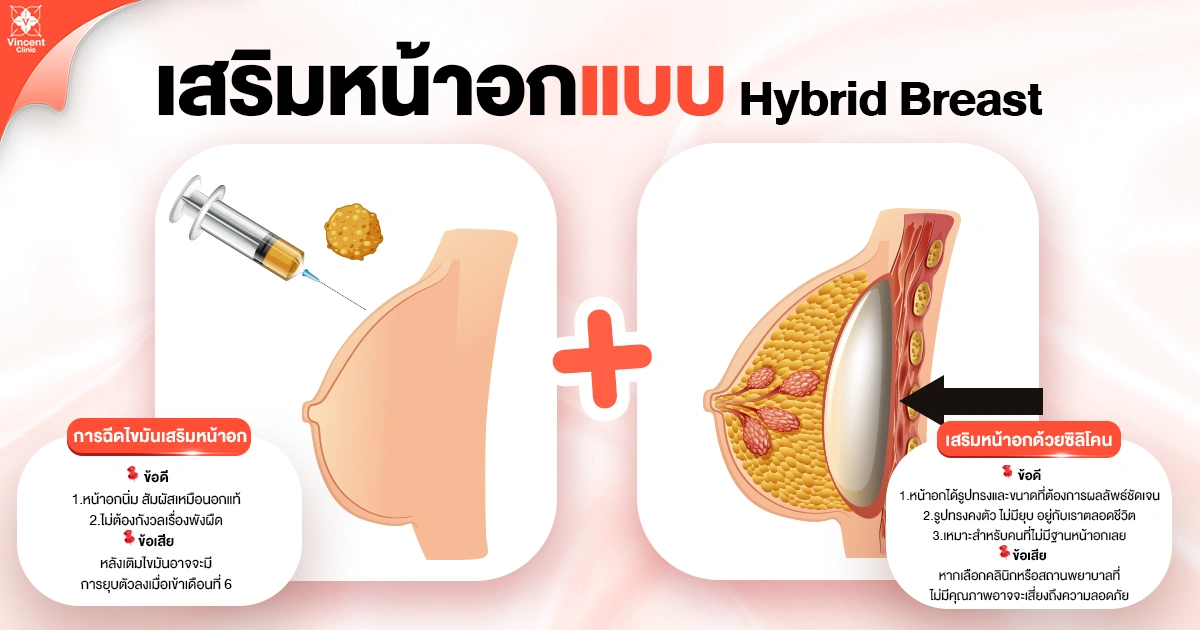 ข้อดี-ข้อเสีย เสริมหน้าอกแบบ Hybrid Breast Augmentation