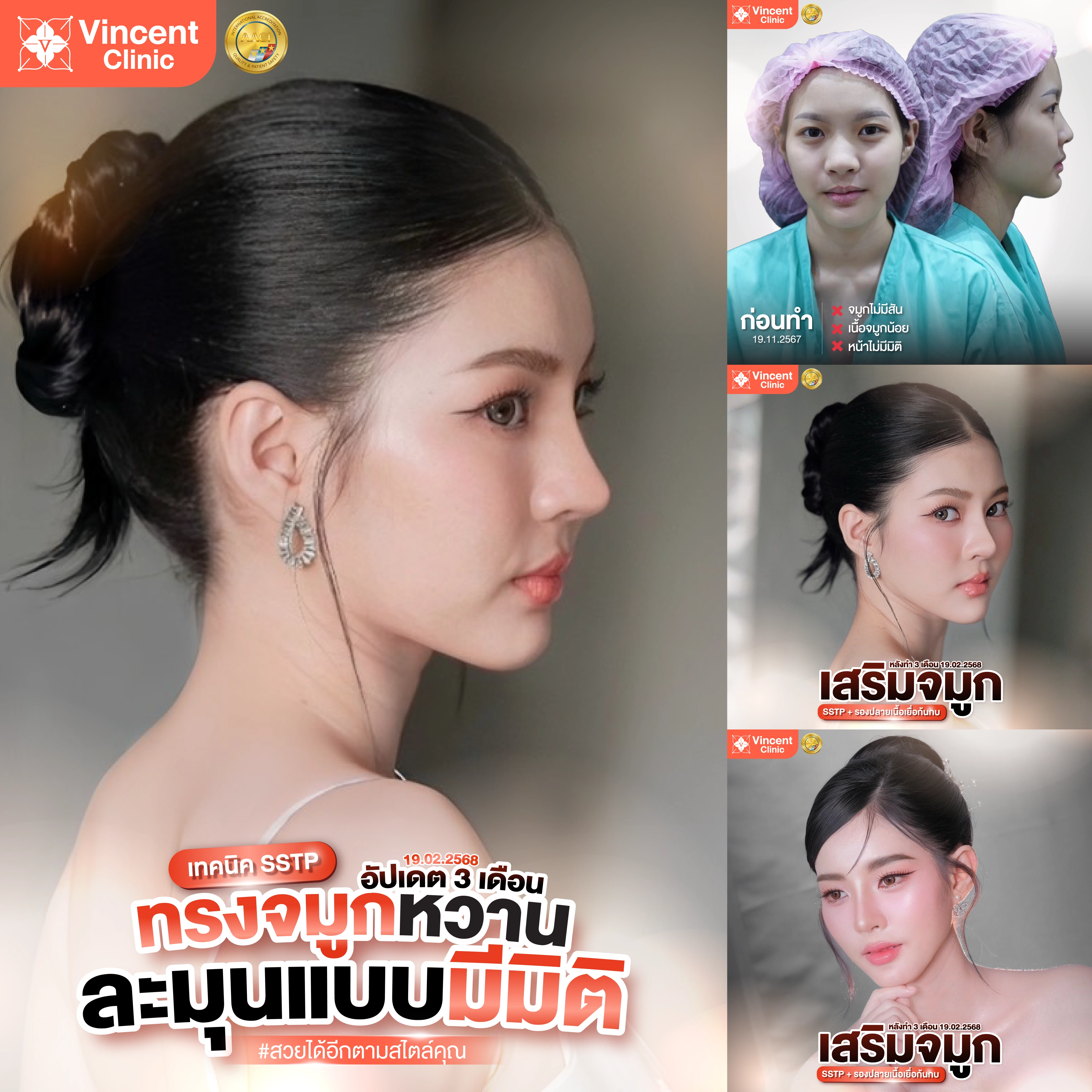 Rhinoplasty review