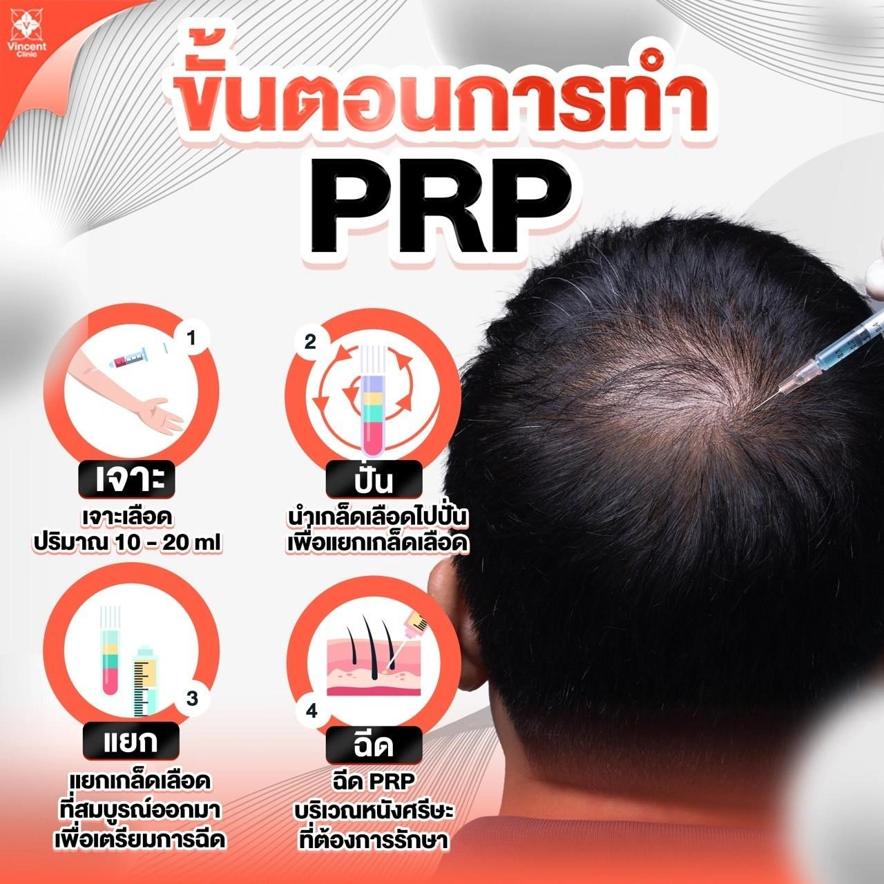ขั้นตอนการทำPRP