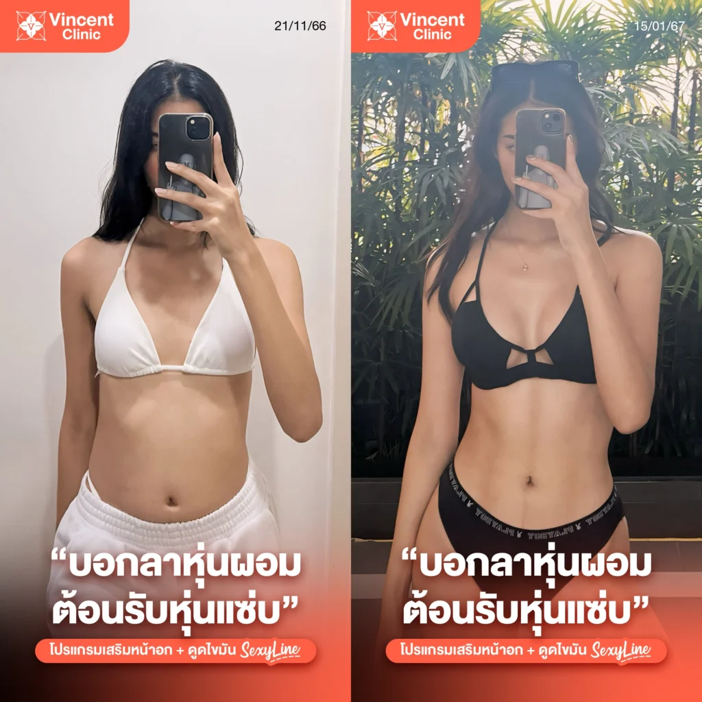 รีวิวดูดไขมัน Sexy Line