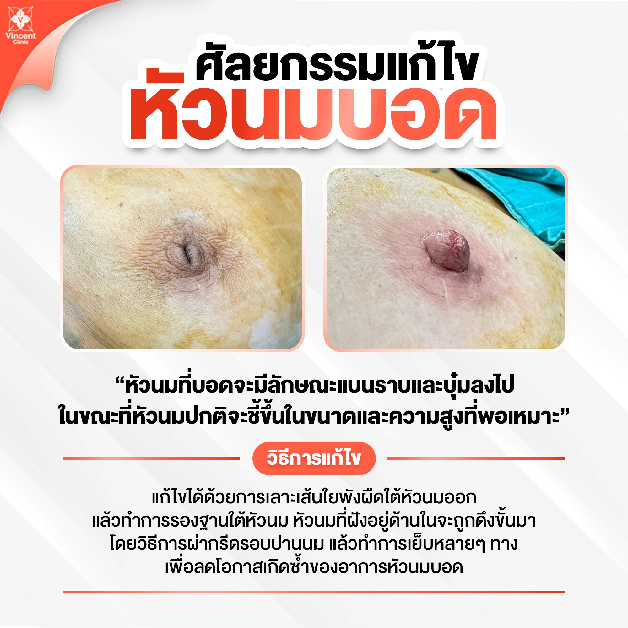 ศัลยกรรมแก้ไขหัวนมบอด