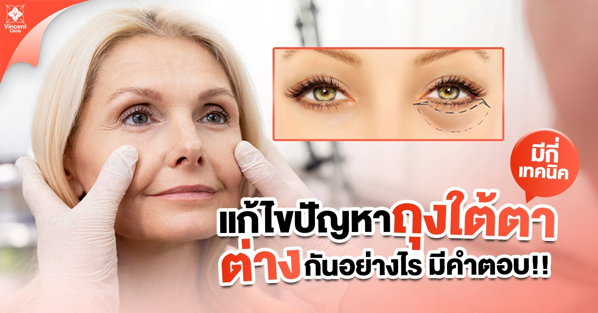 ถุงใต้ตา