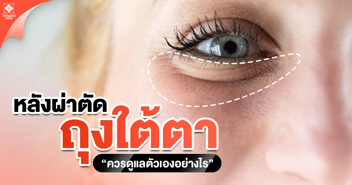 หลังตัดถุงใต้ตา ควรดูแลตัวเองอย่างไร
