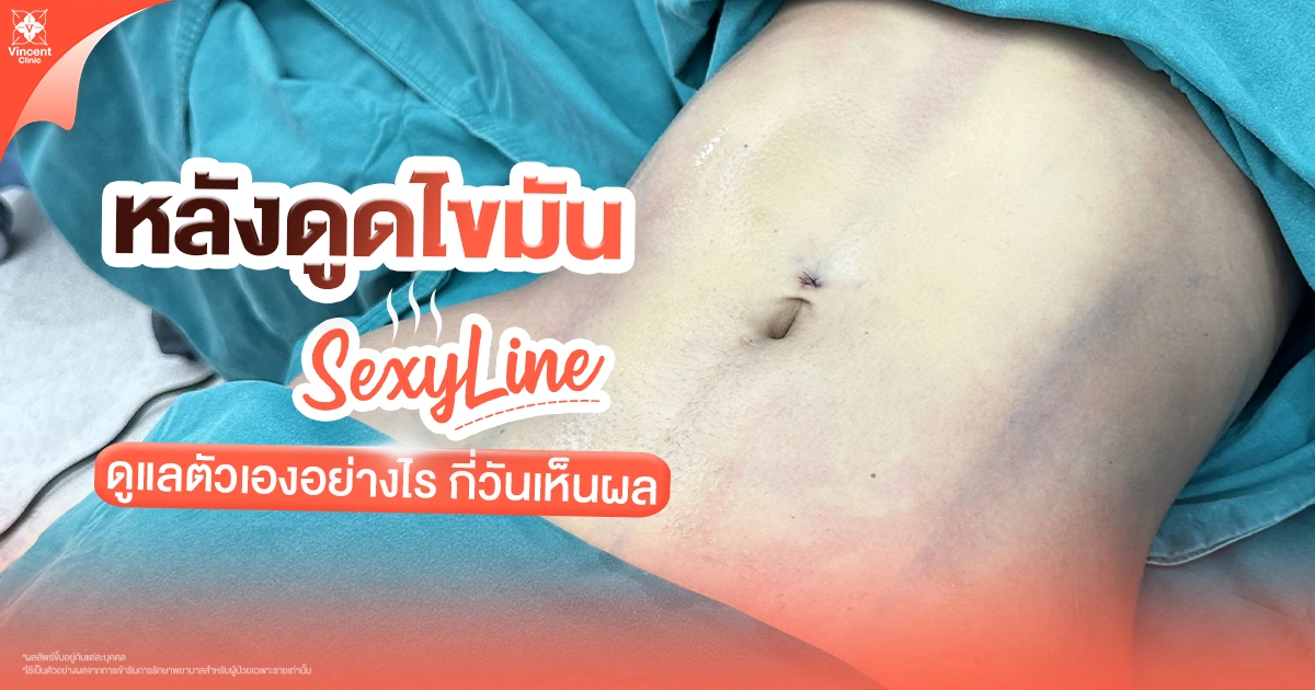 ดูแลตัวเองหลังดูดไขมัน Sexy Line อย่างไร?
