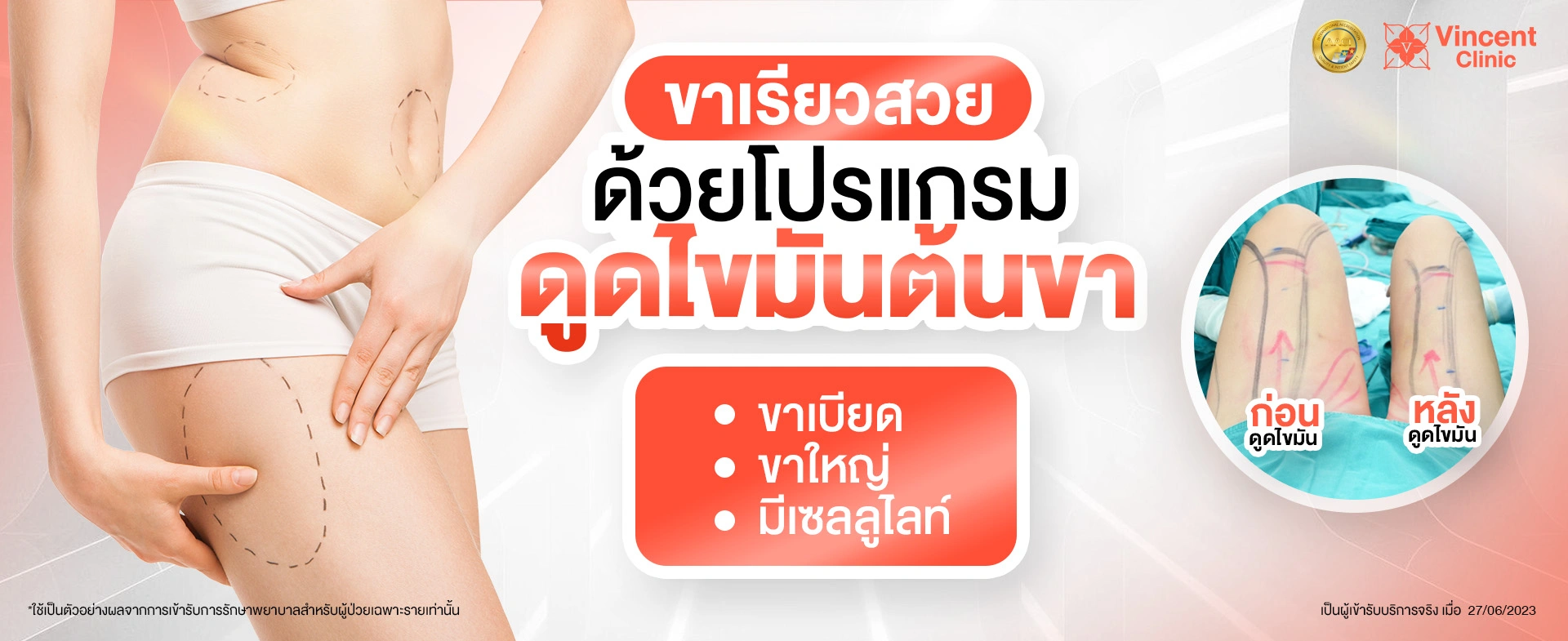 ดูดไขมันขา