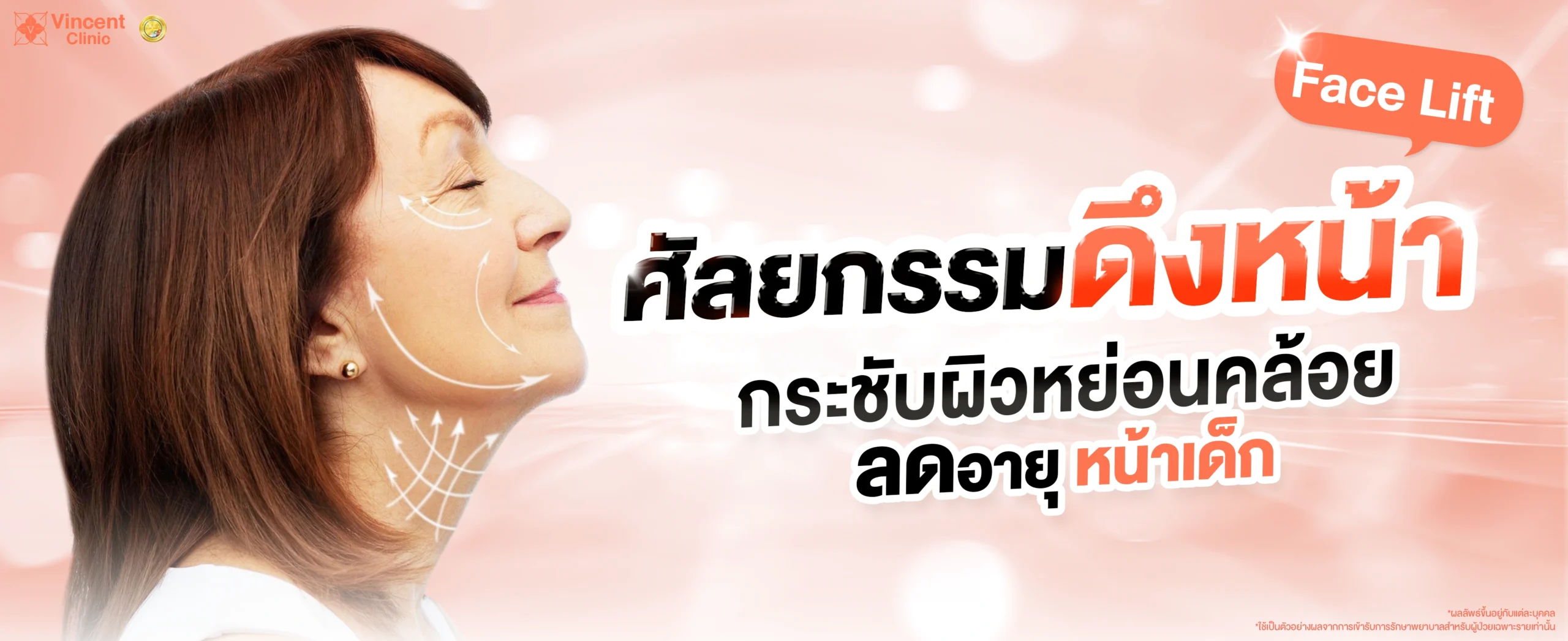 ศัลยกรรมดึงหน้า