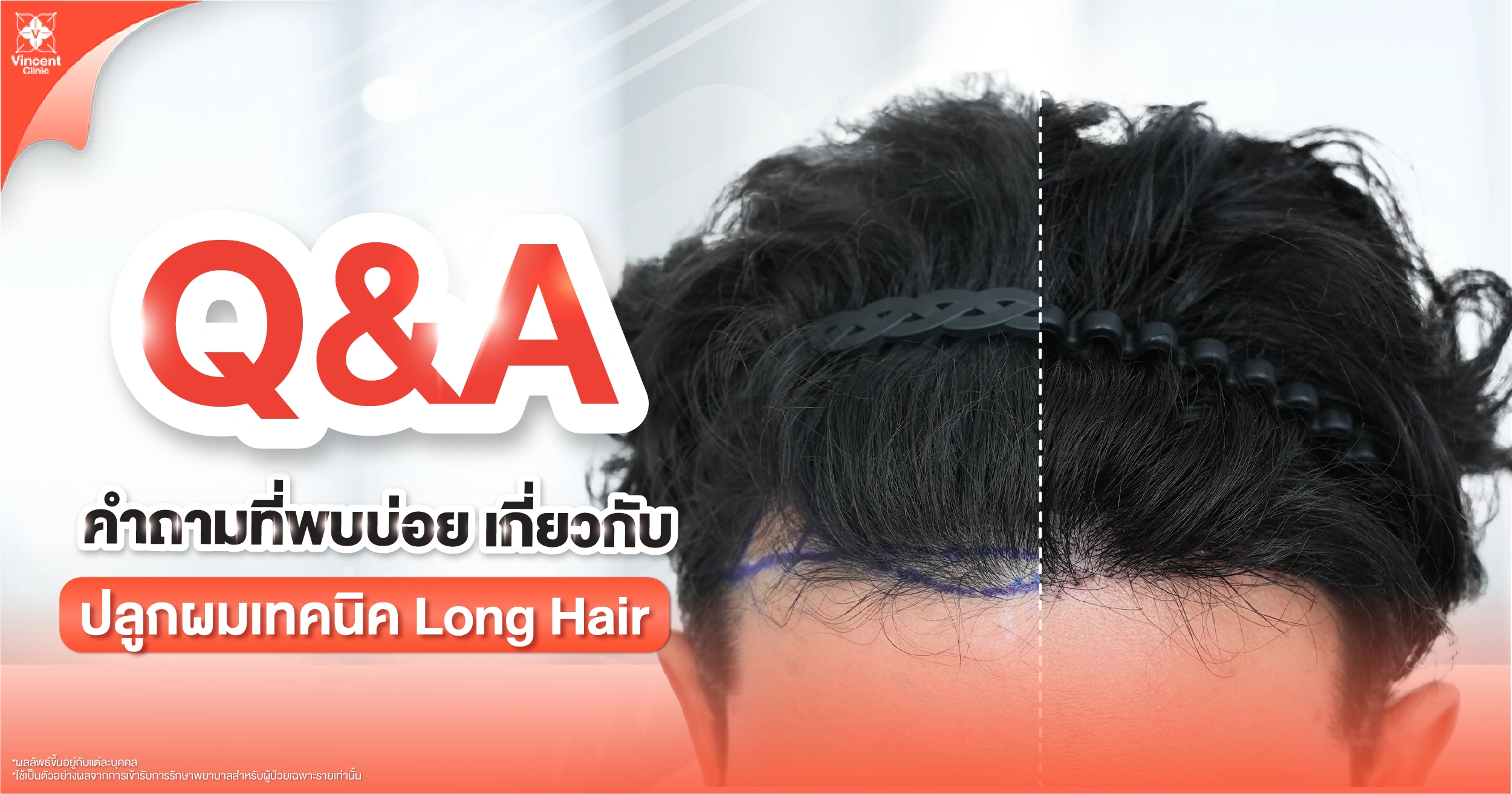 คำถามที่พบบ่อย (FAQ) เกี่ยวกับการปลูกผม Long Hair