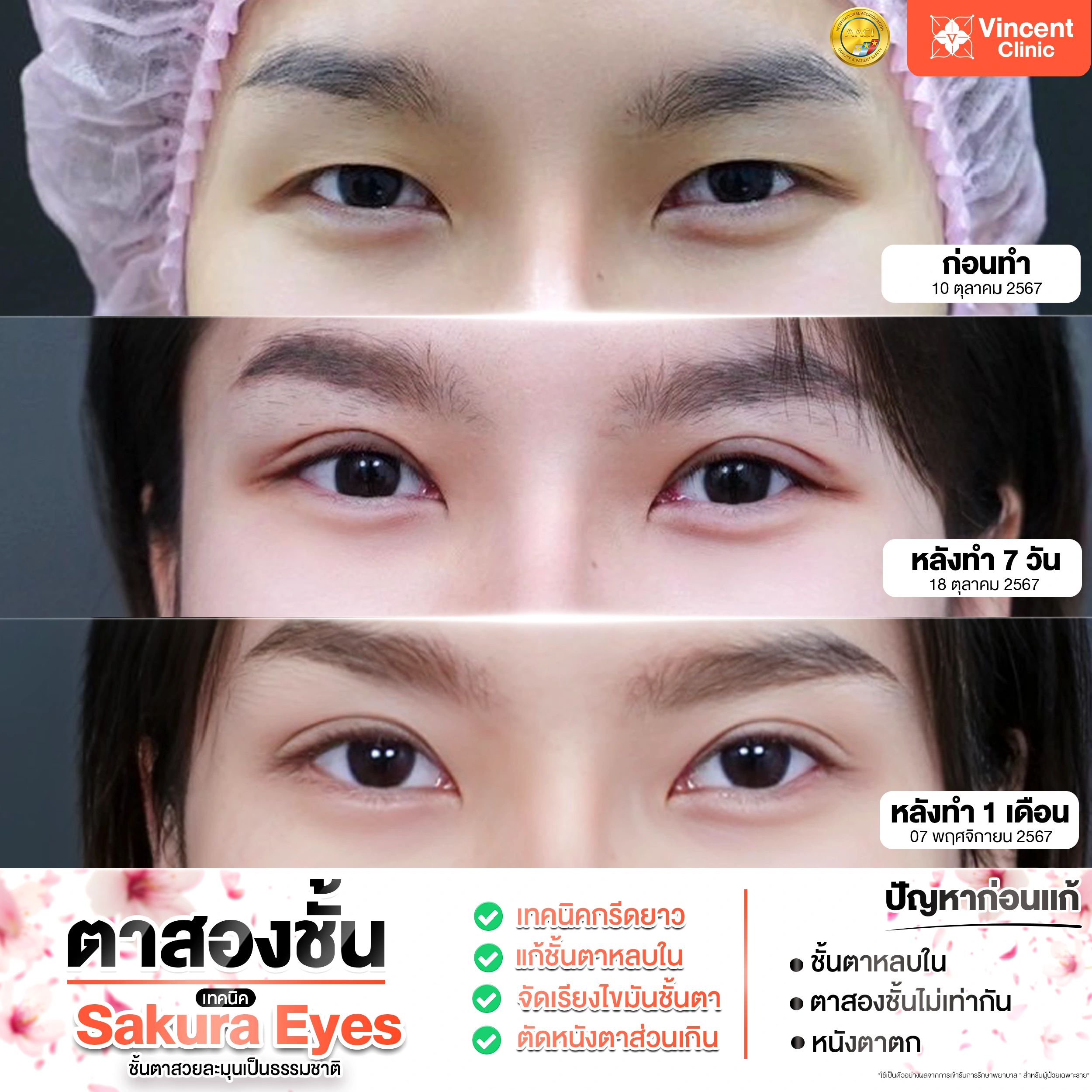 รีวิวจากคนไข้จริงที่เคยทำตาสองชั้น 