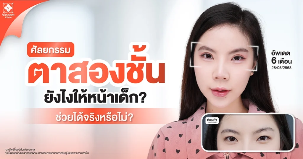 double-eyelid-techniques-for-younger-look