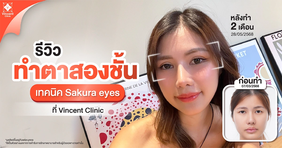 เทคนิคทำตาสองชั้น Sakura Eyes ที่ Vincent Clinic Plastic Surgery