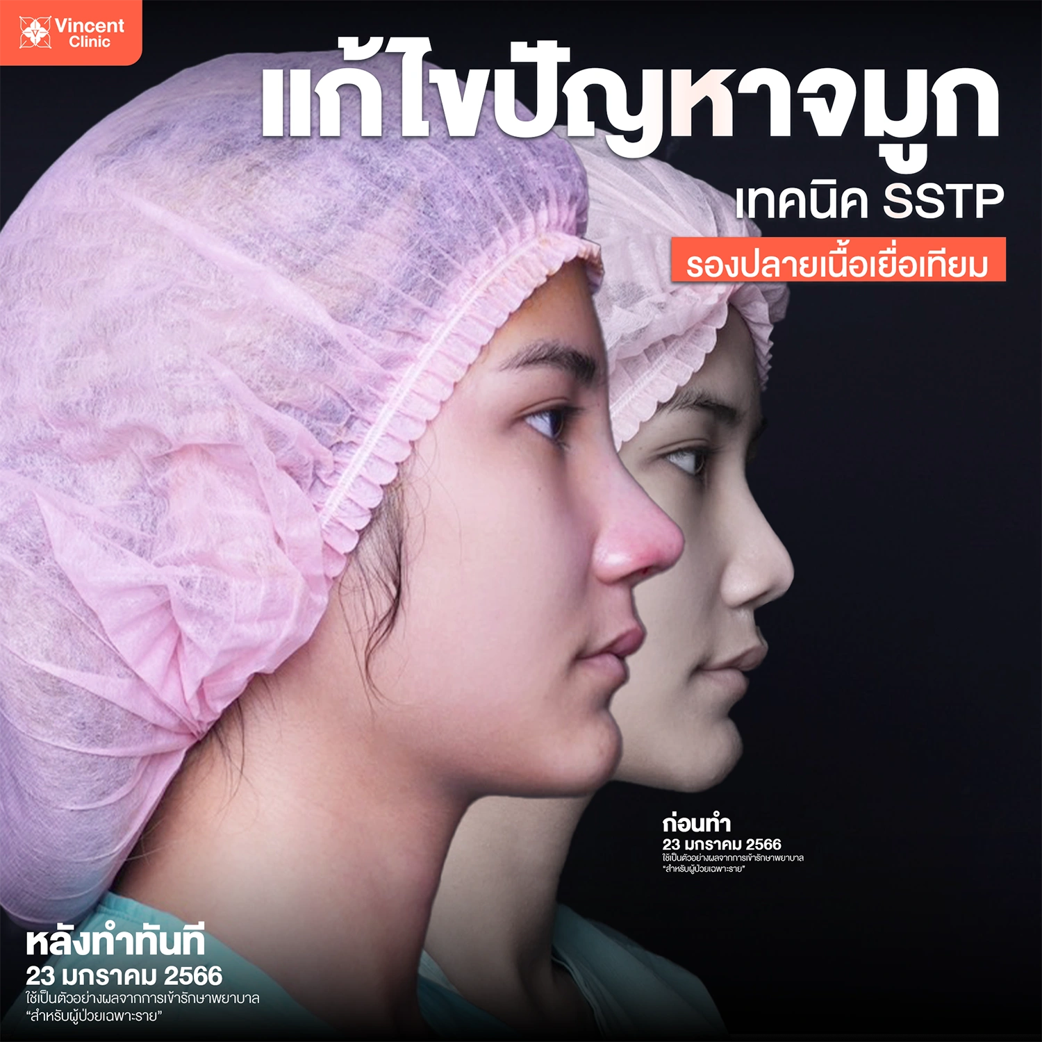 คำถามที่พบบ่อย (FAQ) เกี่ยวกับทรงจมูกเกาหลี