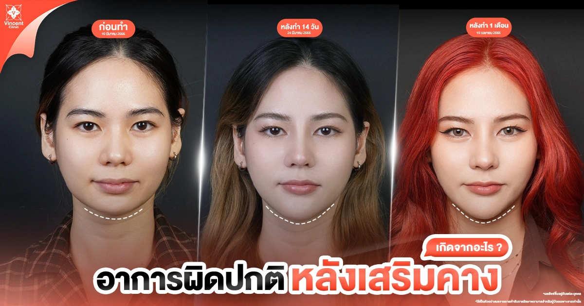 ปัญหาหลังเสริมคางที่พบบ่อยมีอะไรบ้าง