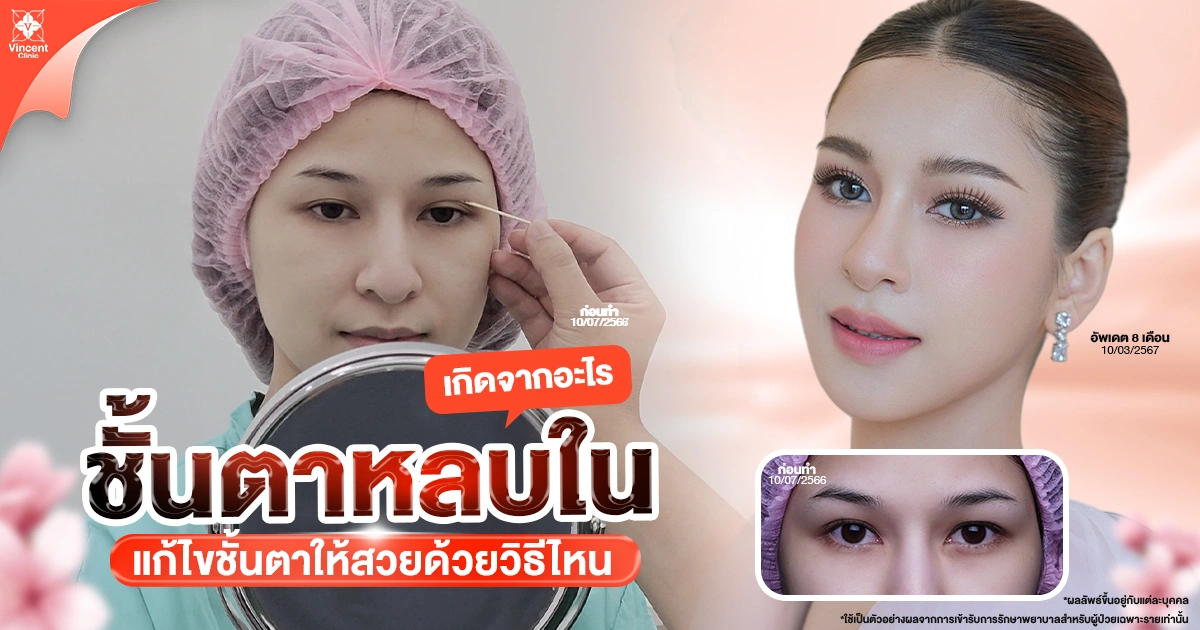 ตาสองชั้นหลบใน