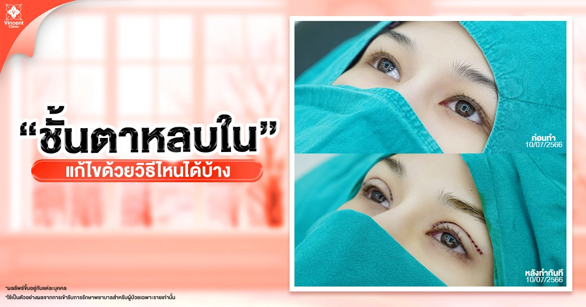 วิธีแก้ตาหลบใน มีอะไรบ้าง