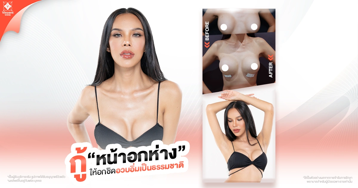 รีวิวเคสศัลยกรรมแก้หน้าอกห่าง