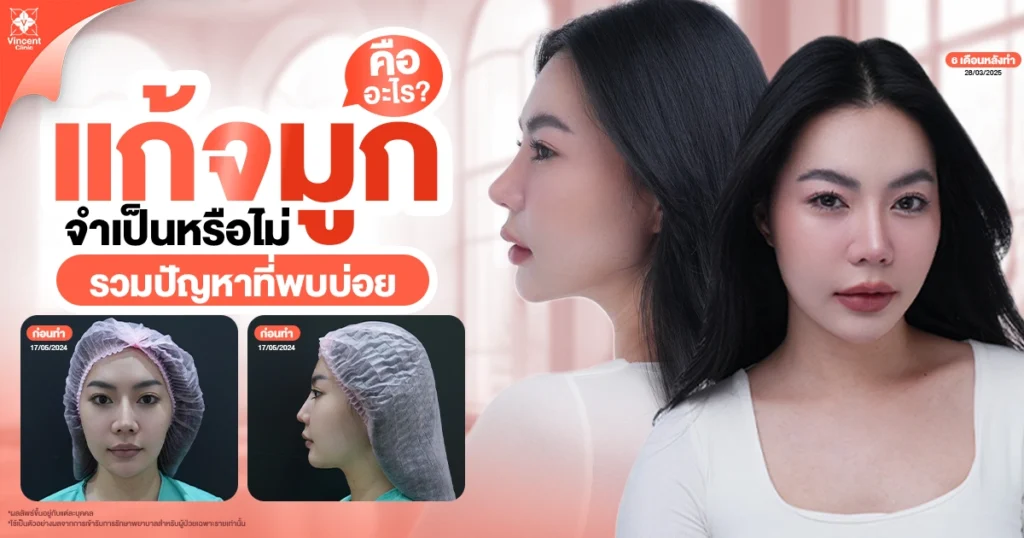 แก้จมูกจำเป็นหรือไม่