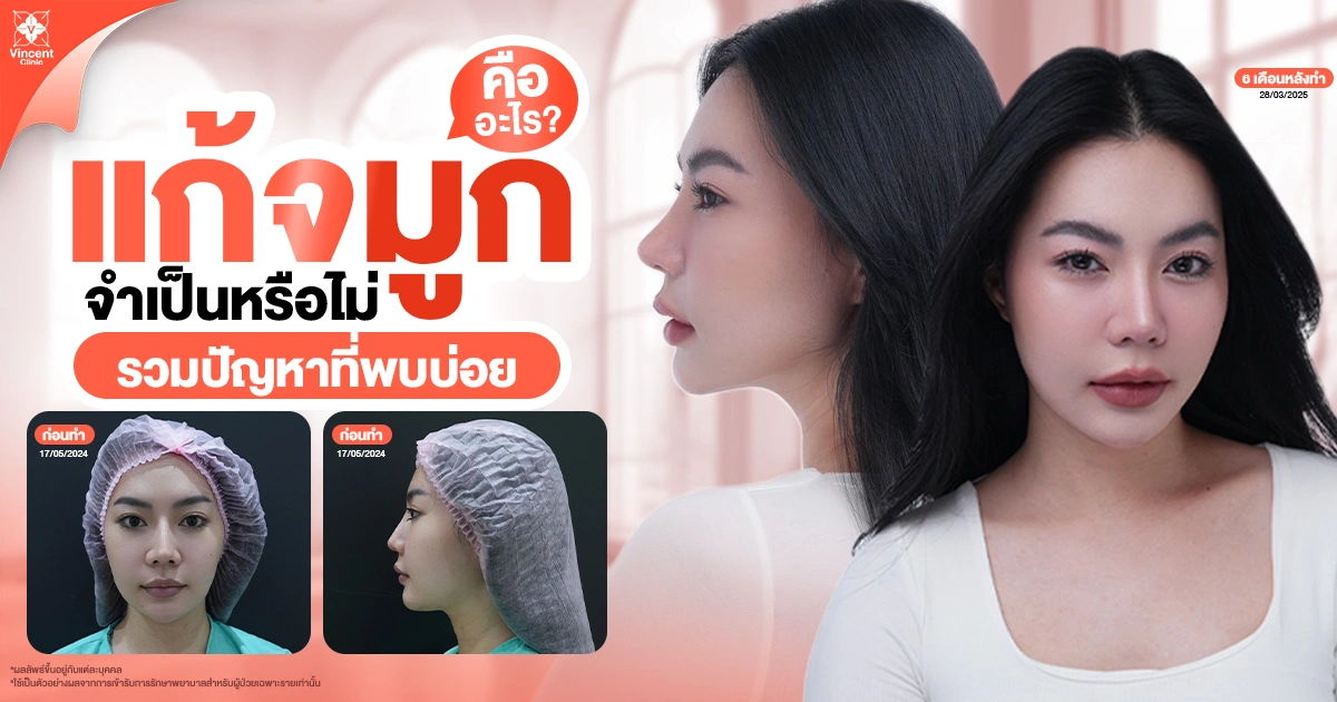 แก้จมูกจำเป็นหรือไม่