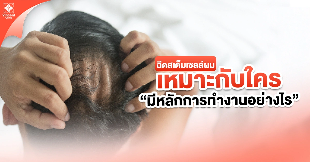 หลักการทำงานของการฉีดสเต็มเซลล์ผม