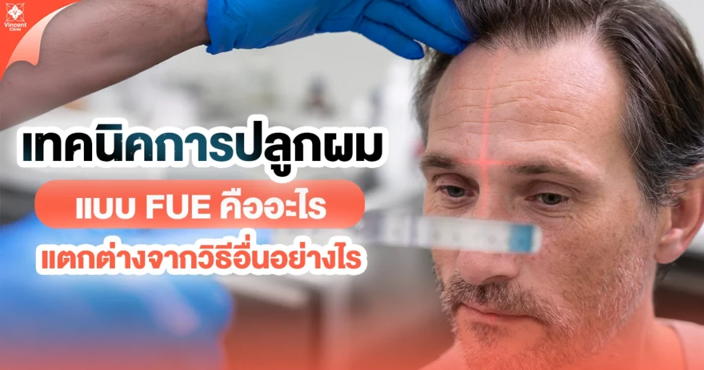 การปลูกผมเทคนิค FUE คืออะไร