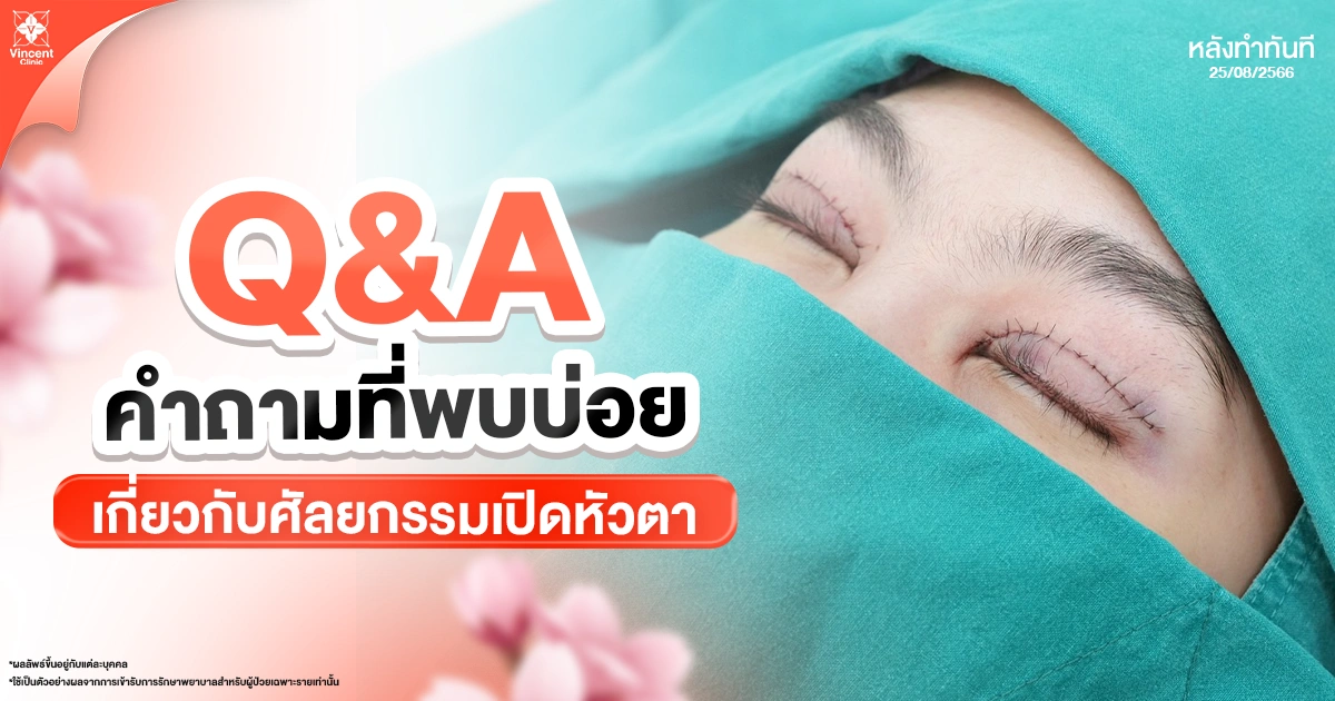 คำถามที่พบบ่อย (FAQ) เกี่ยวกับการเปิดหัวตา