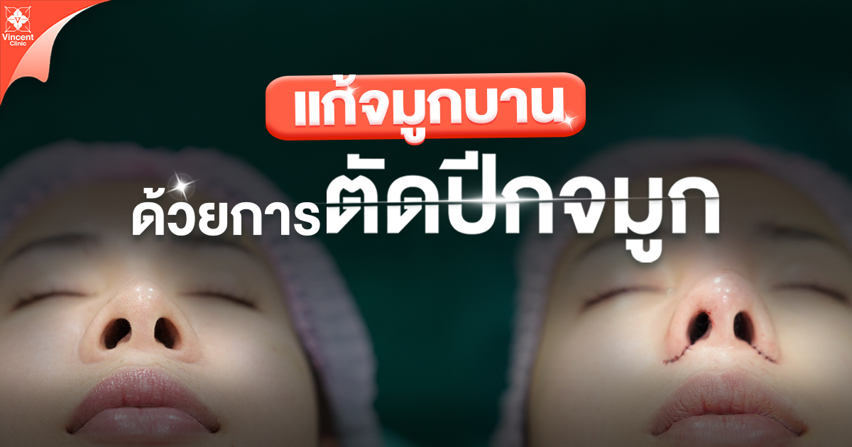 แก้จมูกบานด้วยการตัดปีกจมูก