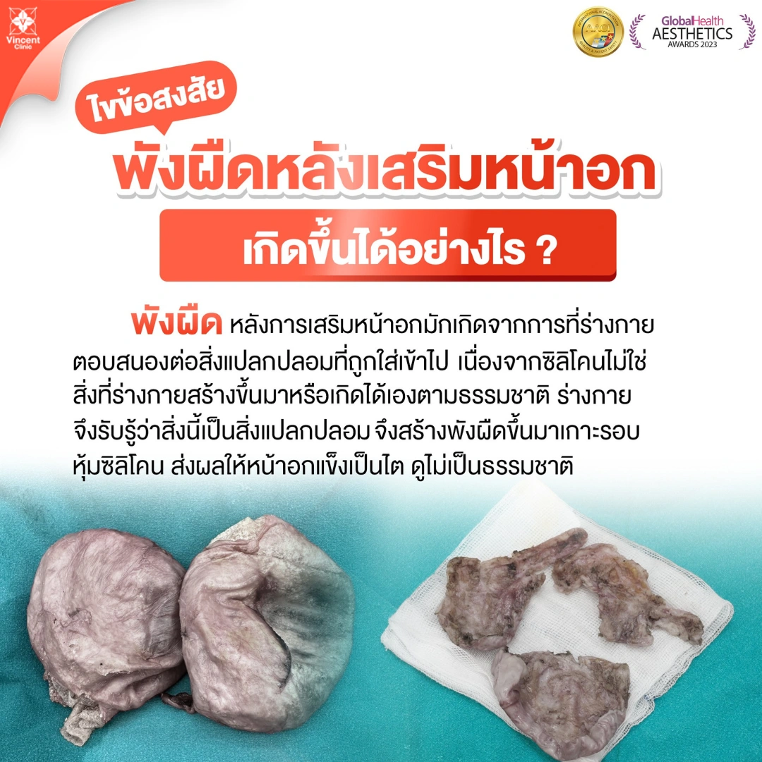 ผังผืดหลังเสริมหน้าอกเกิดขึ้นได้อย่างไร