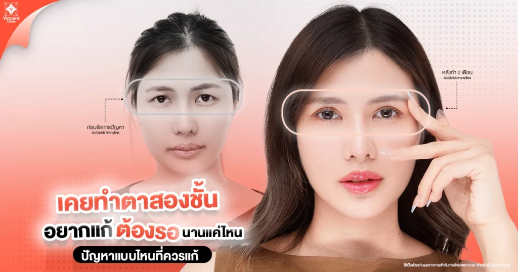 How long do I have to wait to fix my double eyelids?