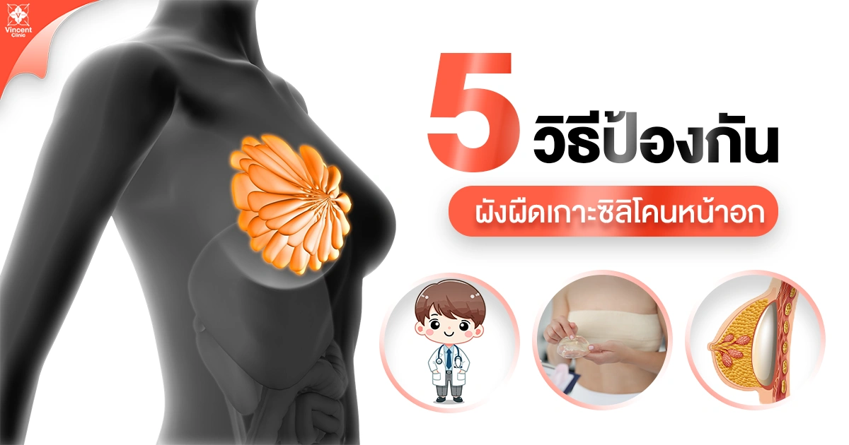 วิธีป้องกันผังผืดเกาะซิลิโคนหน้าอก