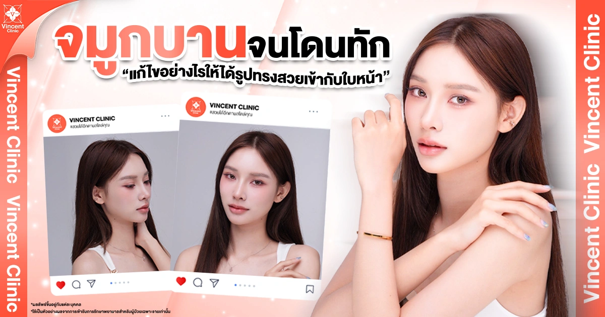 จมูกบานแก้ไขอย่างไร