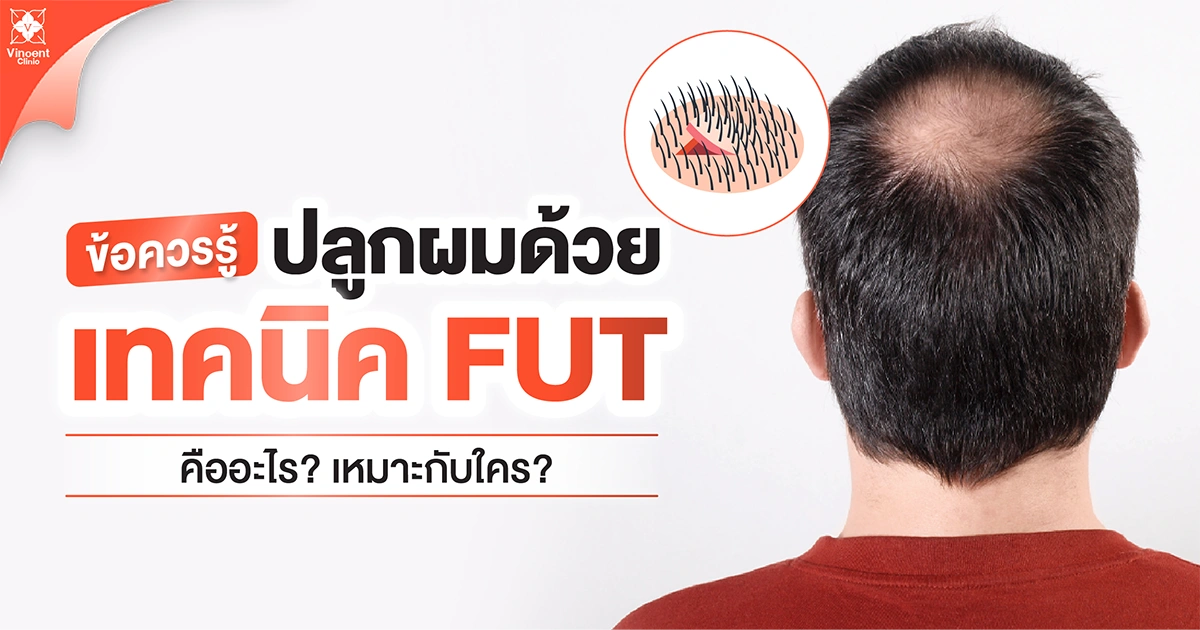 ข้อควรรู้เกี่ยวกีบการปลูกผมเทคนิค FUT