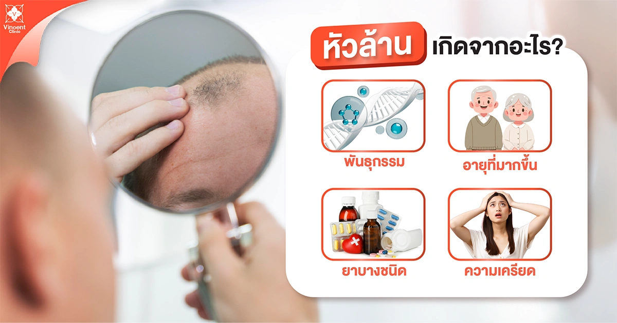 What causes baldness