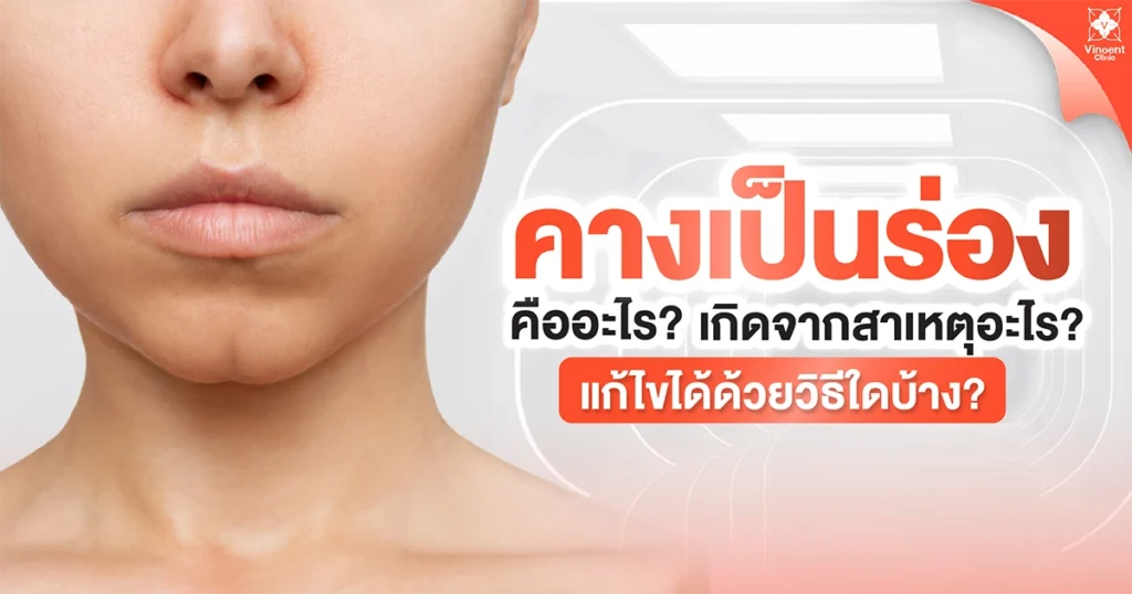 คางเป็นร่องคืออะไร