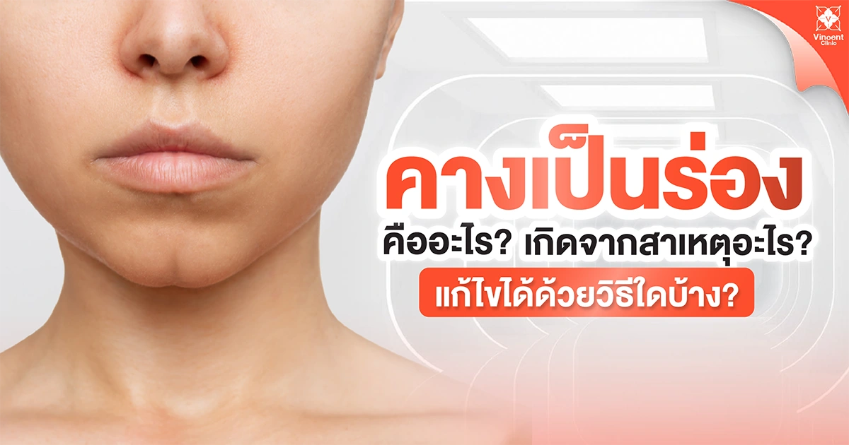 คางเป็นร่องคืออะไร