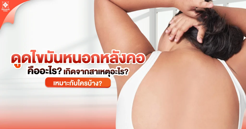 ดูดไขมันหนอกหลังคอ คืออะไร