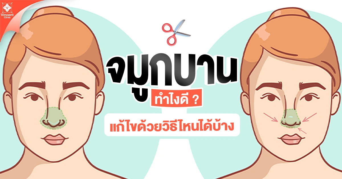 จมูกบานแก้ไขดวยวิธีไหนได้บ้าง