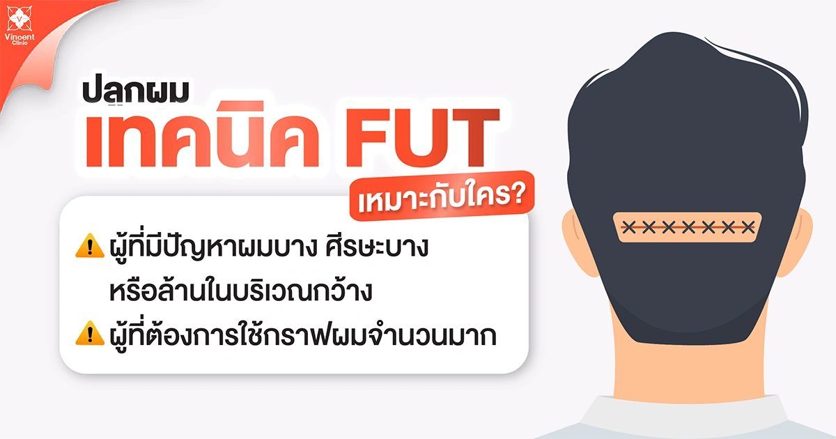 ปลูกผมเทคนิค FUT ้หมาะกับใคร