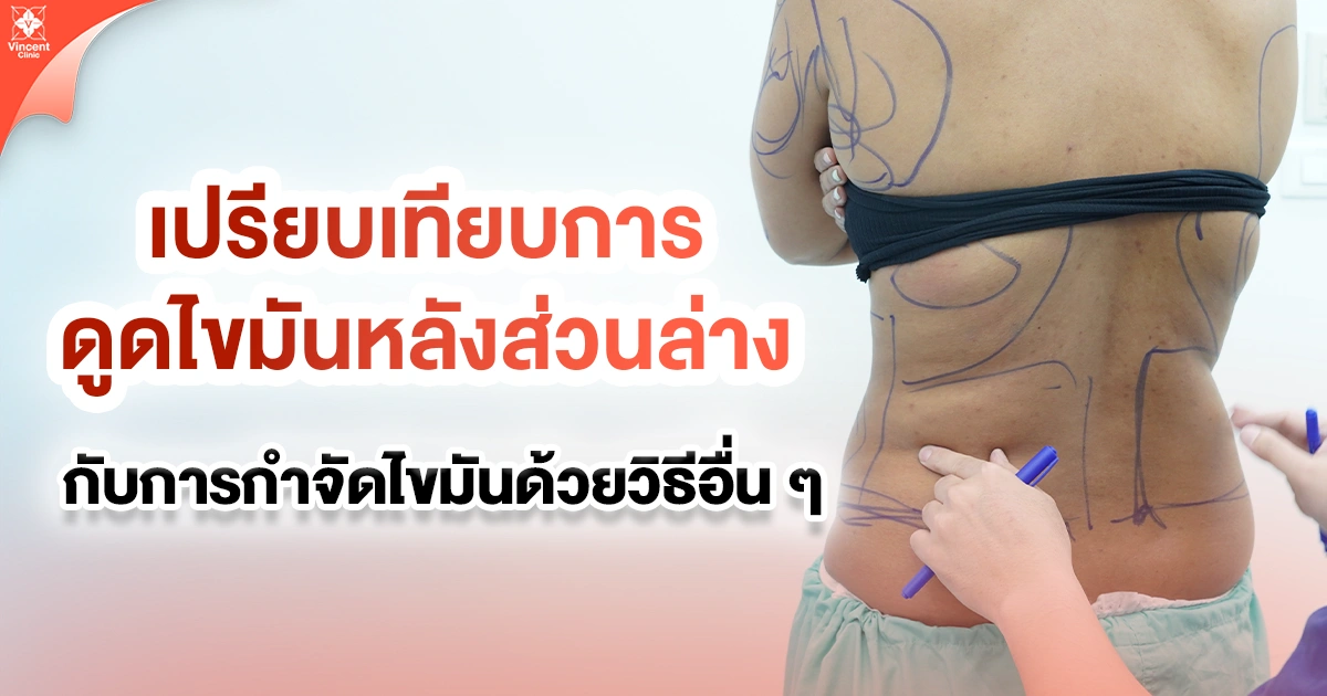 เปรียบเทียบการดูดไขมันหลังส่วนล่างกับการกำจัดไขมันด้วยวิธีอื่นๆ