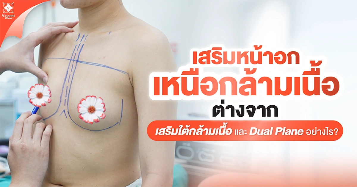เสริมหน้าอกเหนือกล้ามเนื้อต่างจาก เสริมใต้กล้ามเนื้อ และ Dual Plane อย่างไร?