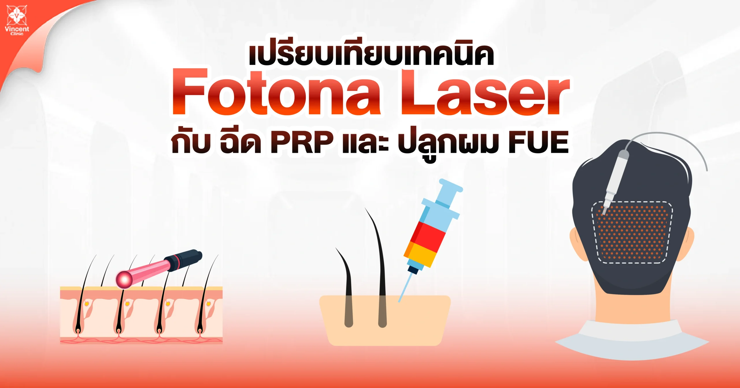 เปรียบเทียบเทคนิค Fotona Laser กับ ฉีด PRP และ ปลูกผม FUE