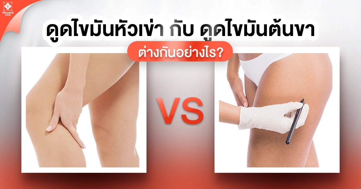 ดูดไขมันหัวเข่ากับดูดไขมันต้นขา ต่างกันอย่างไร