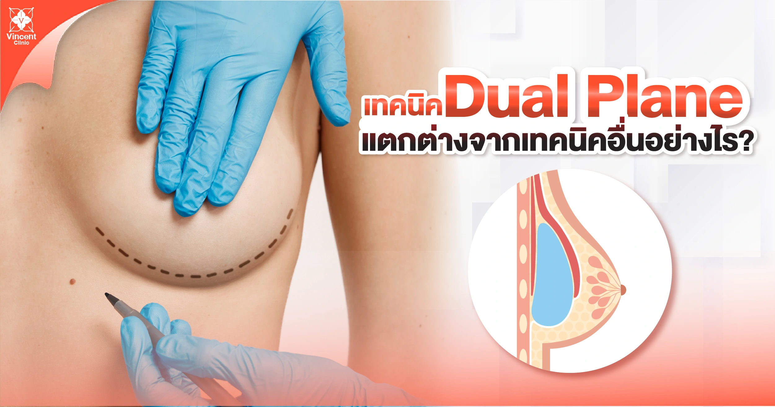 เทคนิค dual plane ต่างจากเทคนิคอื่นอย่างไร