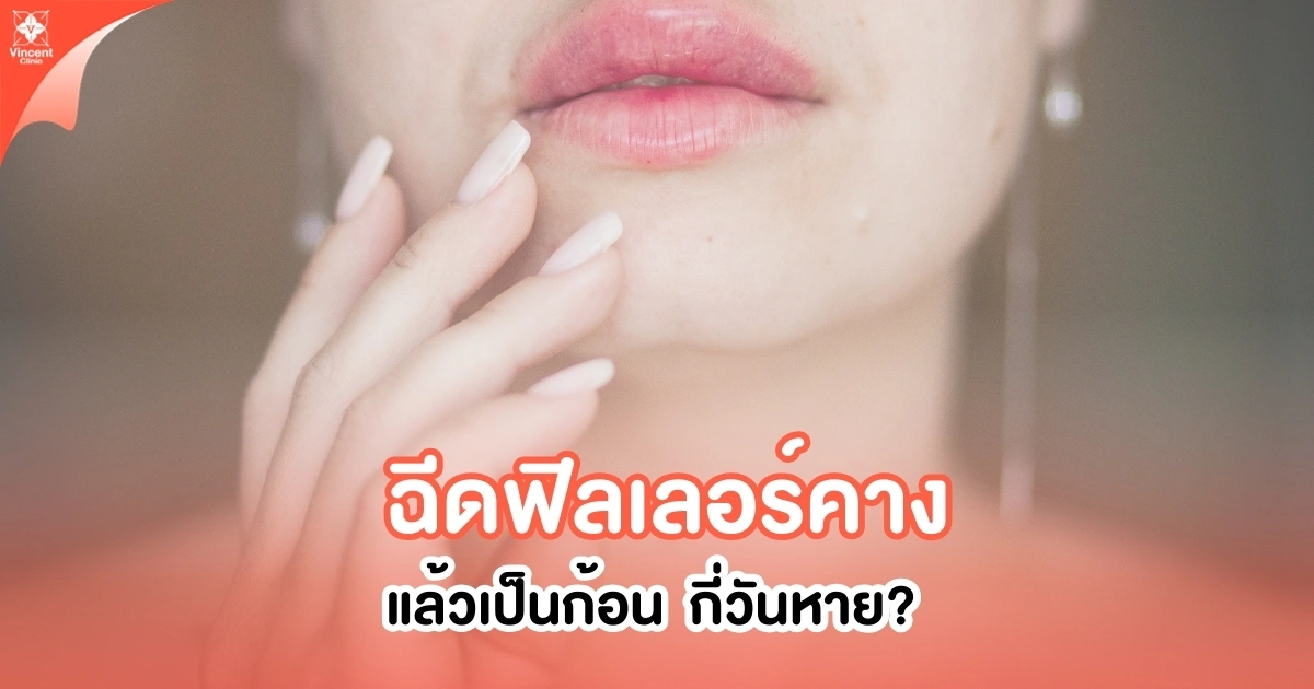 ฟิลเลอร์คางเป็นก้อน กี่วันหาย