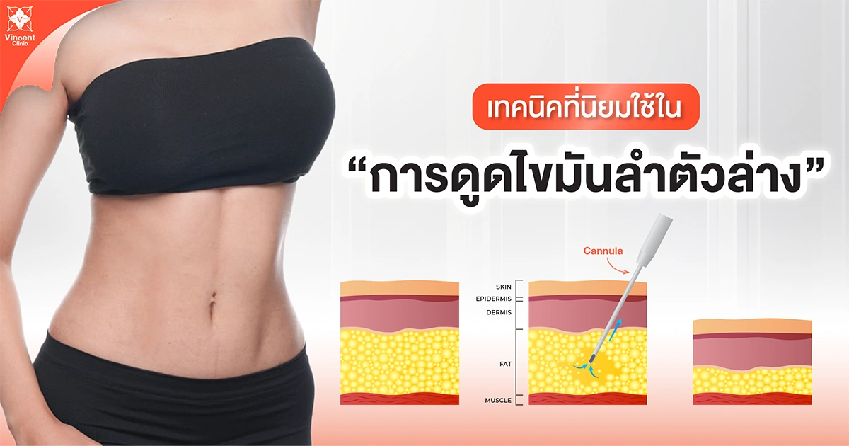เทคนิคที่นิยมใช้ในการดูดไขมันลำตัวล่าง