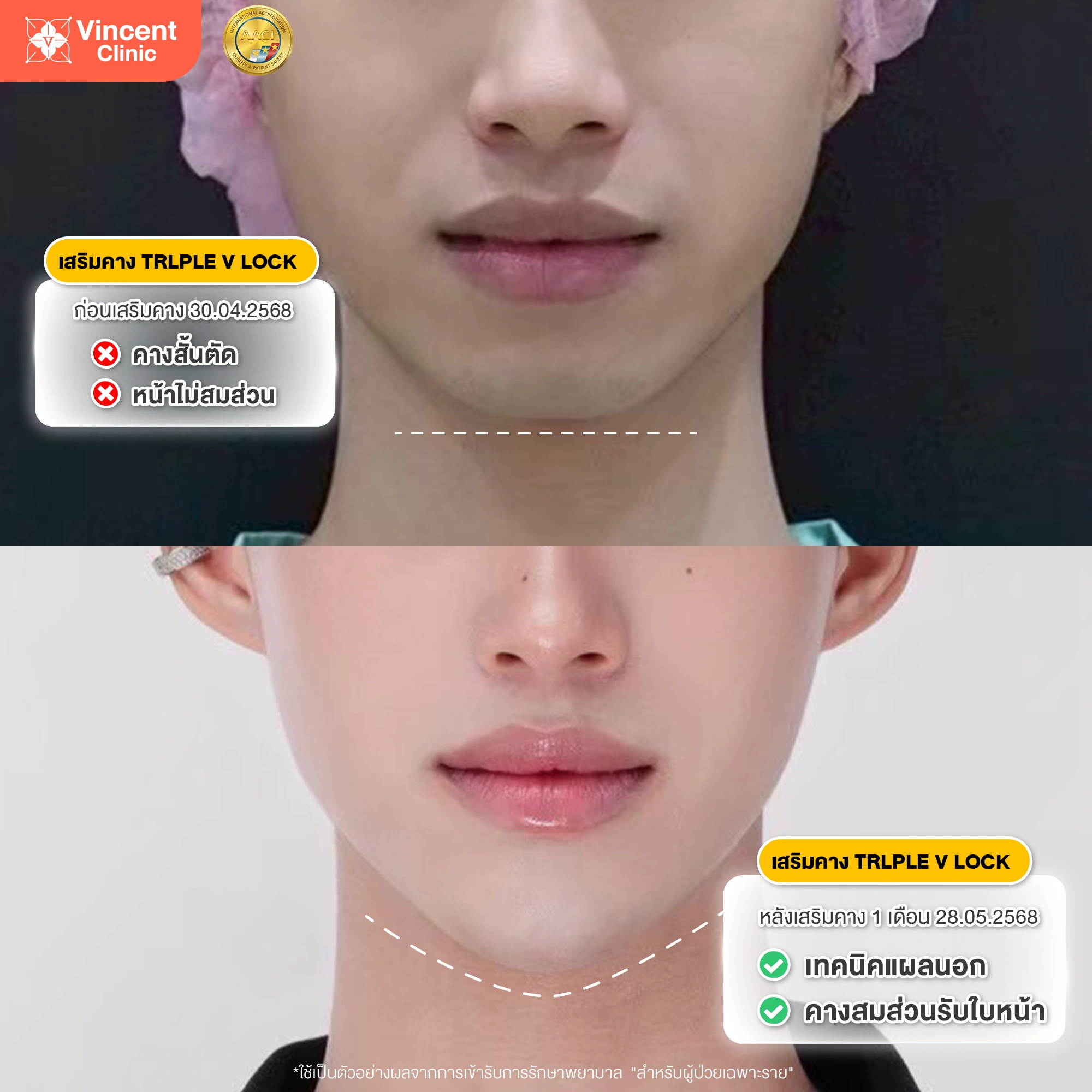 case review chin