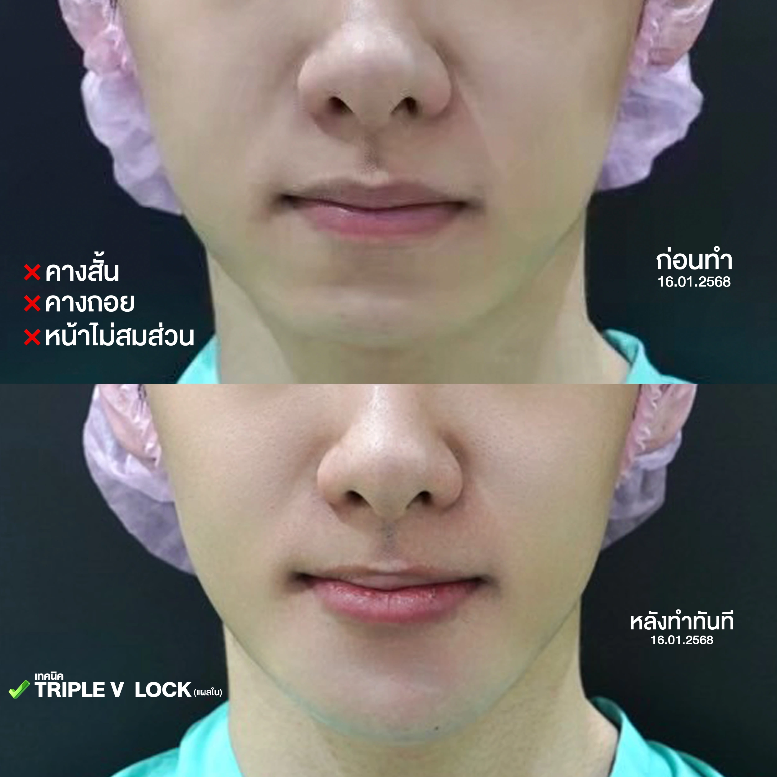 review chin